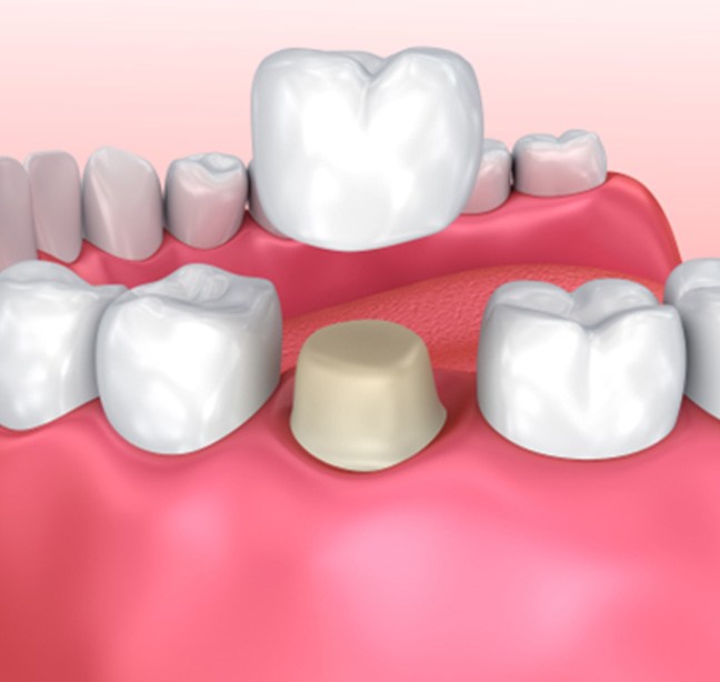 Model of dental crown over prepped tooth  