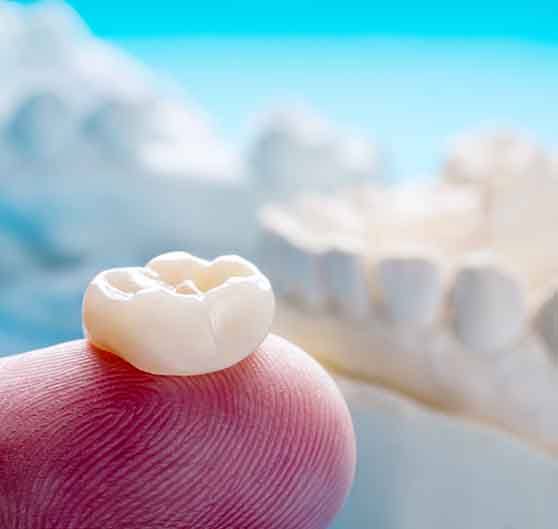 Crown resting on a fingertip with model jaw in background