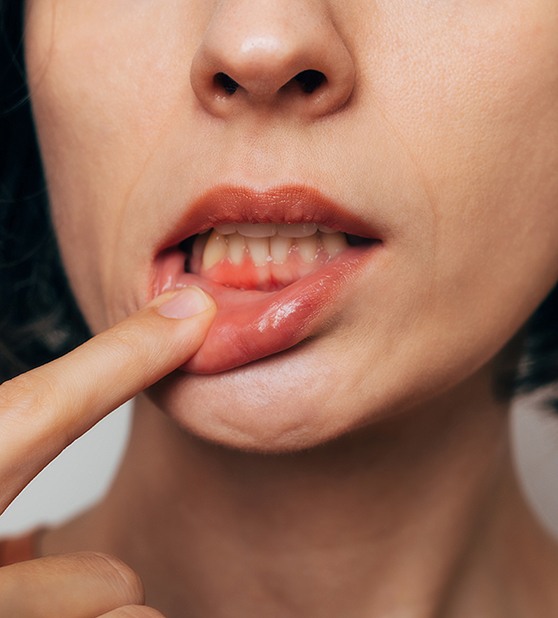 Woman with gum irritation