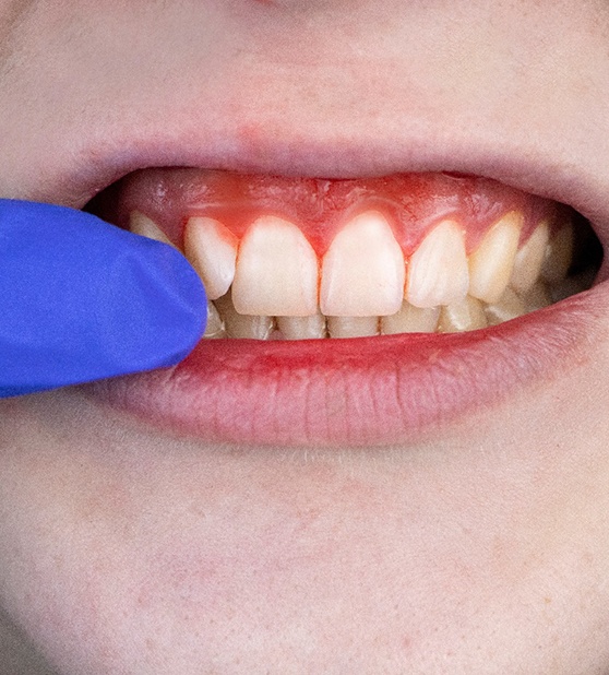 Closeup of bleeding gums