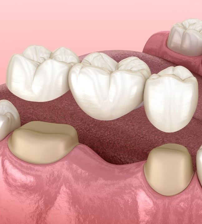 Animated smile during dental bridge placement