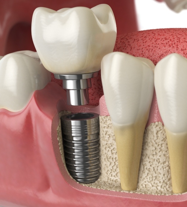 Animated smile during dental implant placement