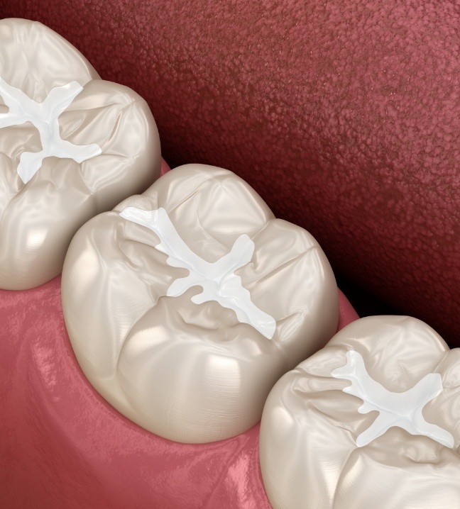 Animated smile with tooth colored fillings