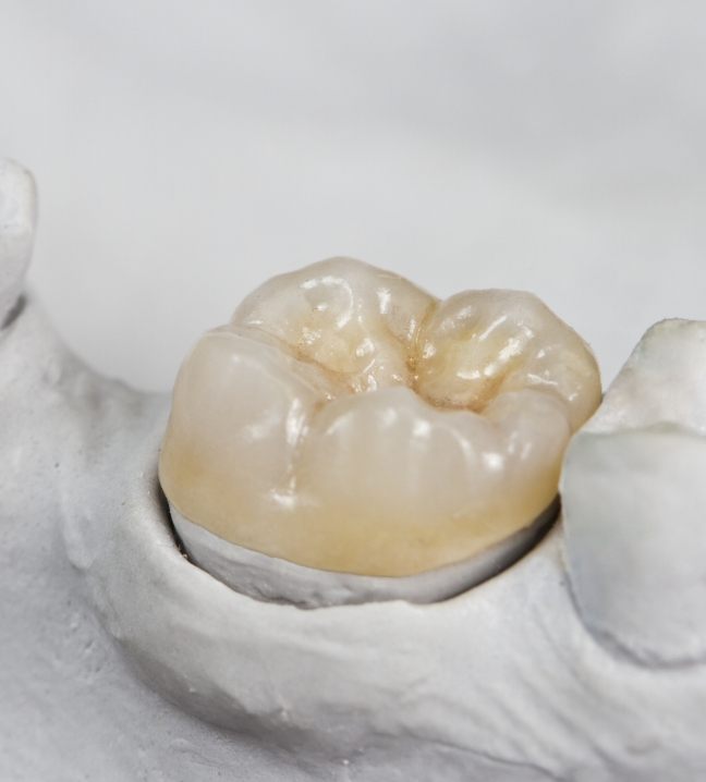 Model smile with dental crown restoration in place