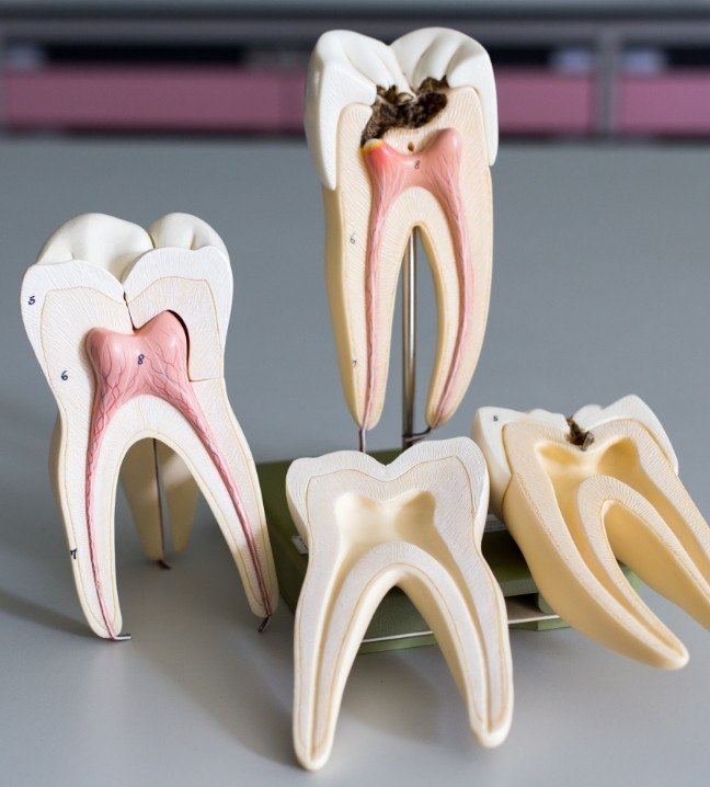 Model of the inside of a healthy tooth and tooth in need of root canal treatment