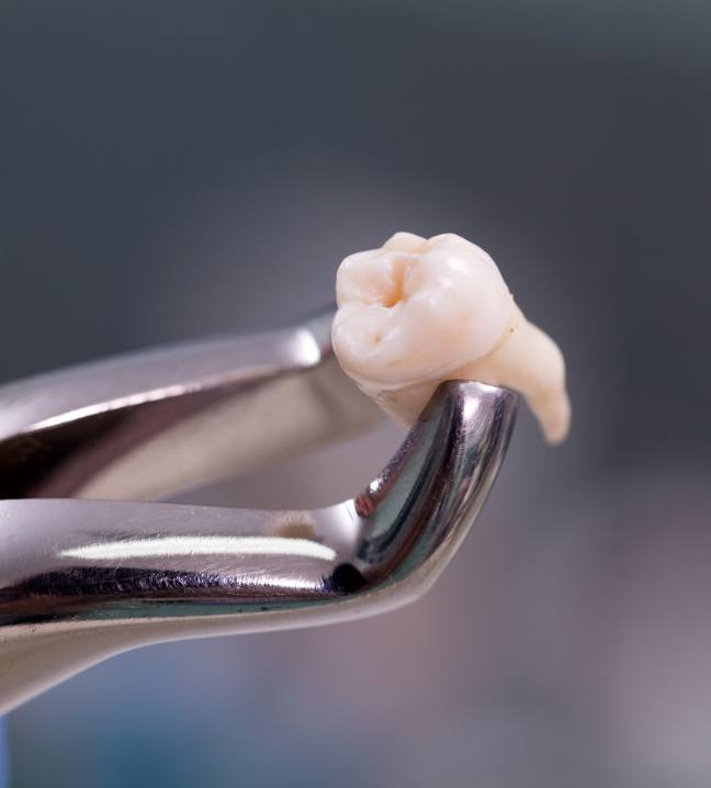 Metal clasp holding an extracted tooth