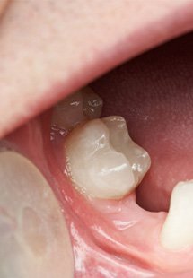 patient with missing tooth 
