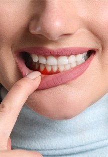 woman pointing to inflamed gums  