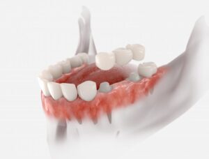 Dental bridge.