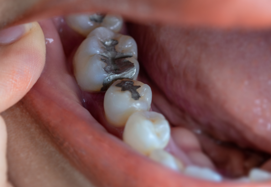 Close up of dental fillings